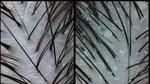 Feature image - How dandruff affects your scalp